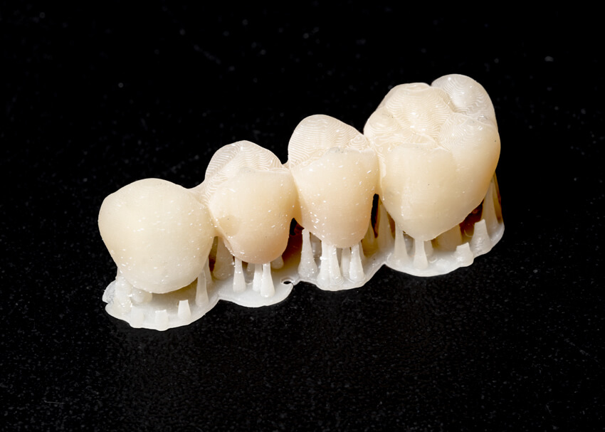 MS Dental - Dentaltechnik - Zahnkronen